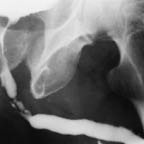 Radiographie d'une sténose de l'urèthre.jpg